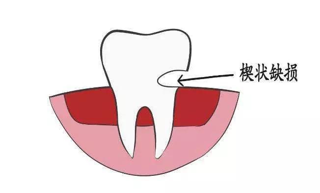 牙釉重度磨耗.jpg